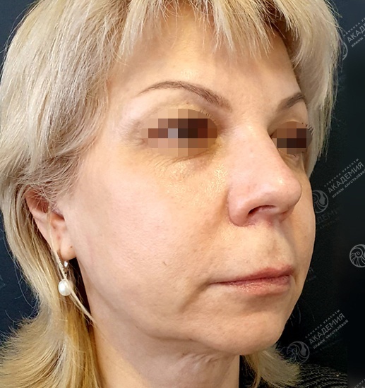 До: Процедура на аппарате Ultraformer