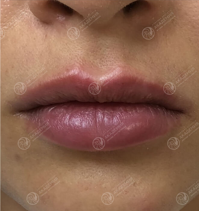 После: Контурная пластика губ препаратом Juvederm Ultra 3 1,0 ml