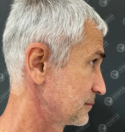 Ракурс 4 после: Full Face и Chin-Wing