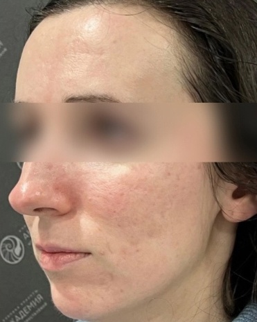Ракурс 2 после: M22 и коллагеностимуляция Sculptra