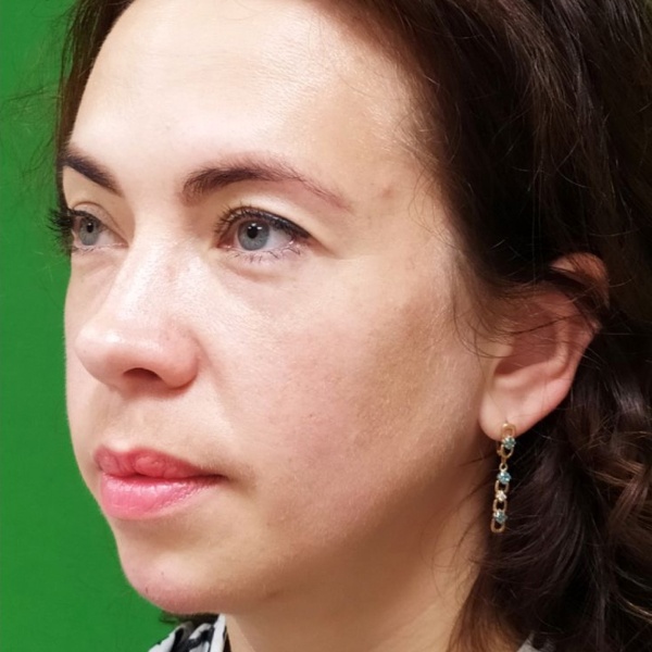 После: Контурная пластика подбородка