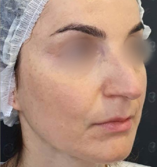 После: Биоревитализация Restyline Vital