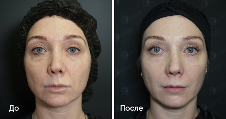 Фотофракшн и инъекционные процедуры