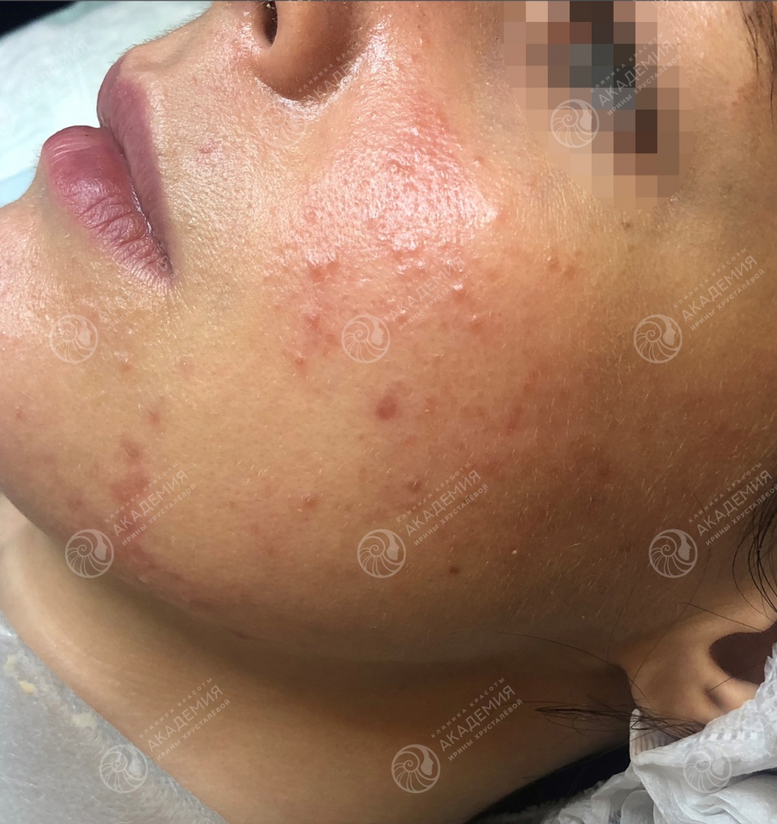 До: Лечение розацеа. Сочетание процедур на аппарате М22 и PRP