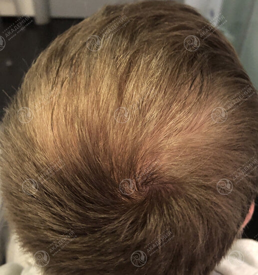 После: 5 процедур Hair X Dna Peptide, 1 раз в неделю