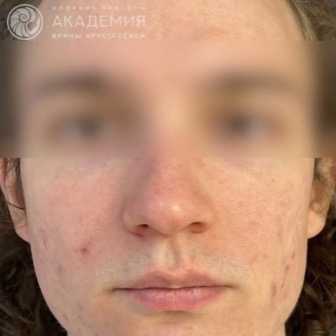 До: 1 процедура фотофракшн, 1 процедура коллагенотерапии