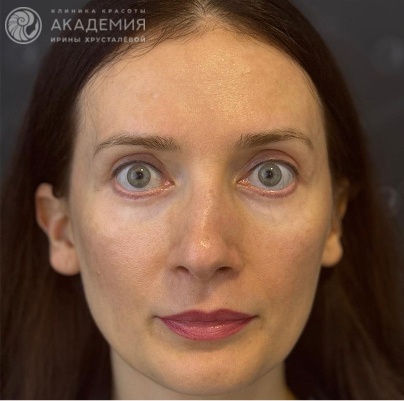 До: Повторный эндоскопический лифтинг средней трети лица и периорбитальной области, двухсторонняя кантопластика методом «tarsal strip», удлинение ретракторов нижних век с использованием спейсеров