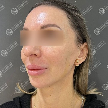 После: Комплекс процедур полимолочной кислоты Aesthefill в средней и нижней трети лица, сферогель fine в носослезной борозде, Artfiller Volume в области подбородка.