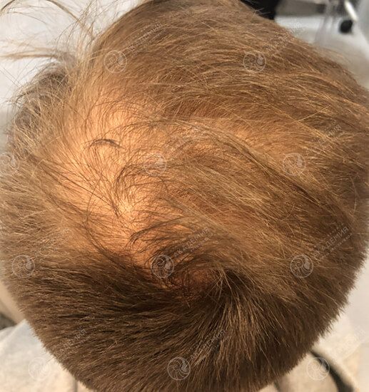 До: 5 процедур Hair X Dna Peptide, 1 раз в неделю