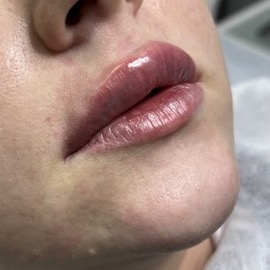 После: Коррекция губ препаратом Stylage lips