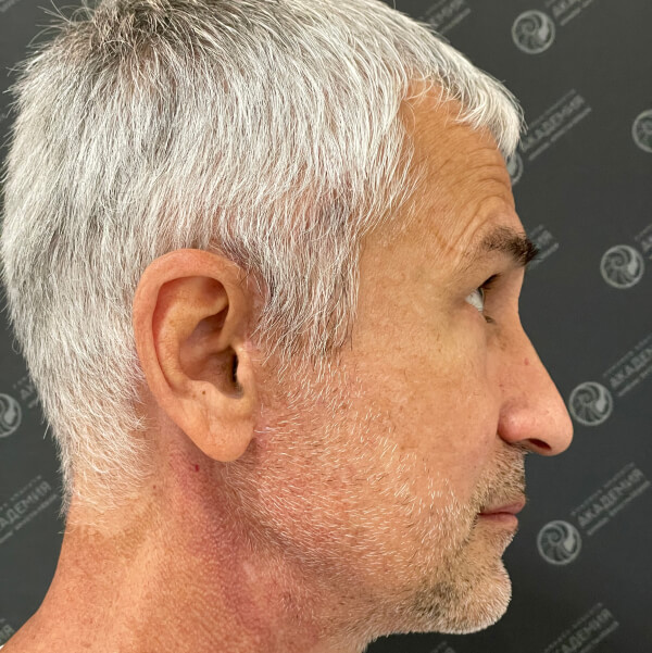 Ракурс 2 после: Full Face и Chin-Wing
