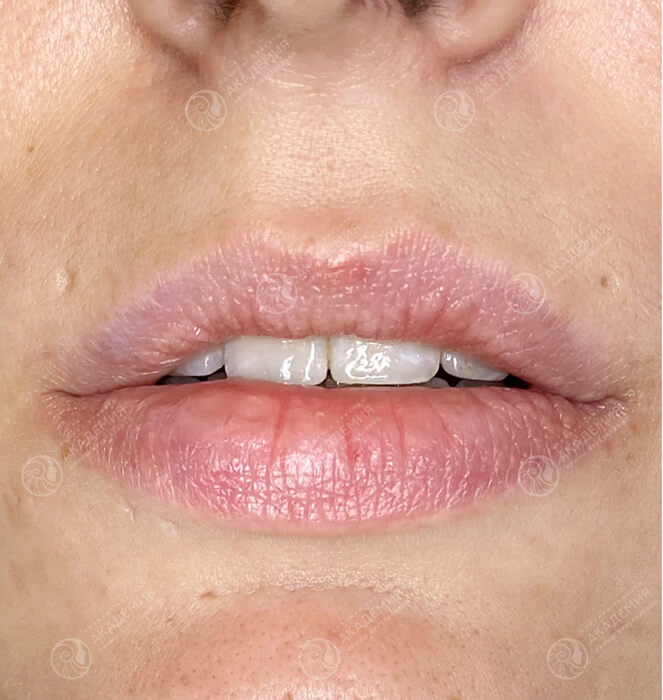 До: Контурная пластика губ препаратом Juvederm Smile