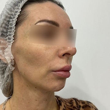 Ракурс 2 до: Комплекс процедур полимолочной кислоты Aesthefill