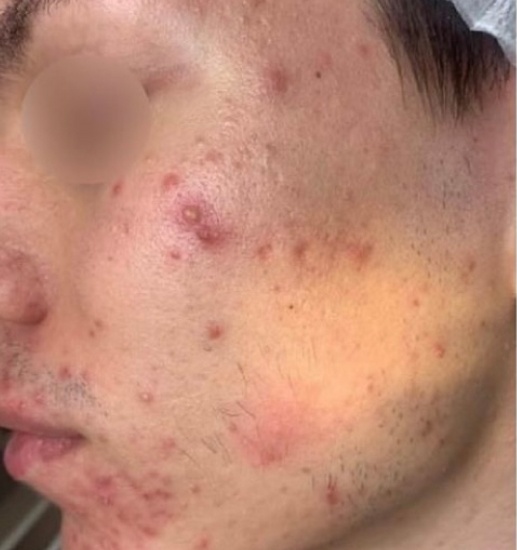 До: Комплексное лечение акне с помощью инъекционных методик, фототерапии и дерматологической терапии.