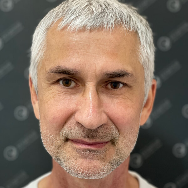 После: Full face (все отделы лица), операция на подбородке Chin-Wing.