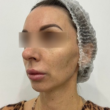 До: Комплекс процедур полимолочной кислоты Aesthefill в средней и нижней трети лица, сферогель fine в носослезной борозде, Artfiller Volume в области подбородка.