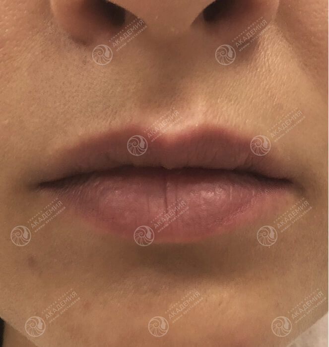 До: Контурная пластика губ препаратом Juvederm Ultra 3 1,0 ml