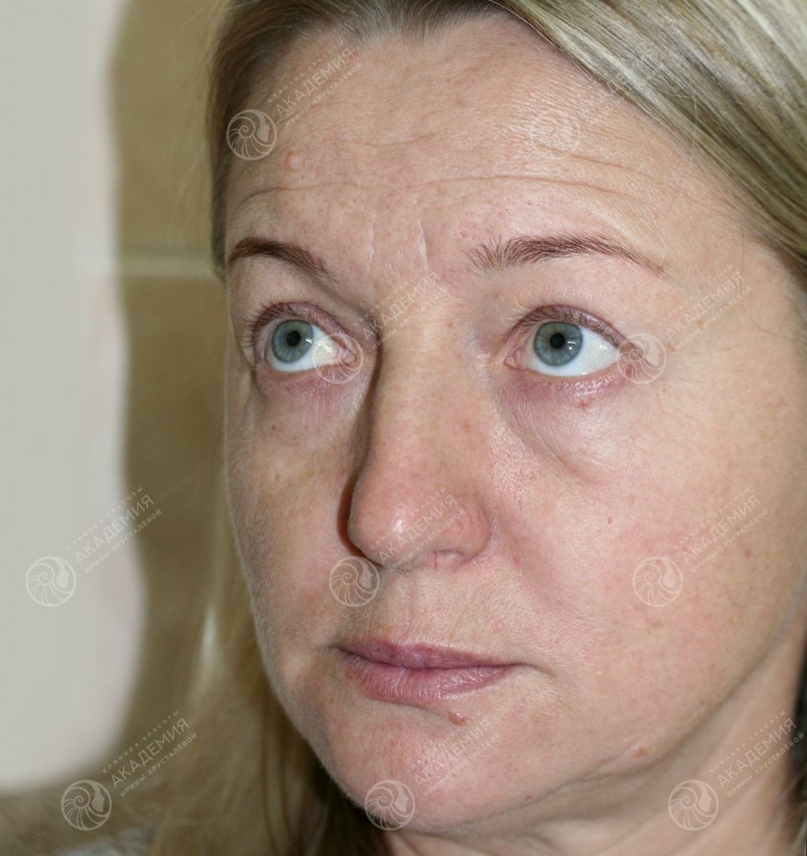 Ракурс 2 до: Эндоскопический лифтинг и блефаропластика