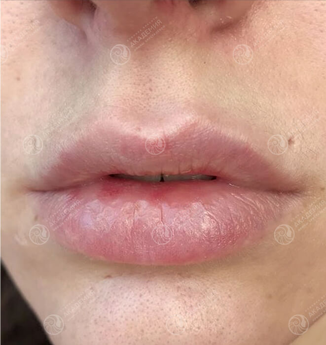 После: Контурная пластика губ препаратом Juvederm Smile
