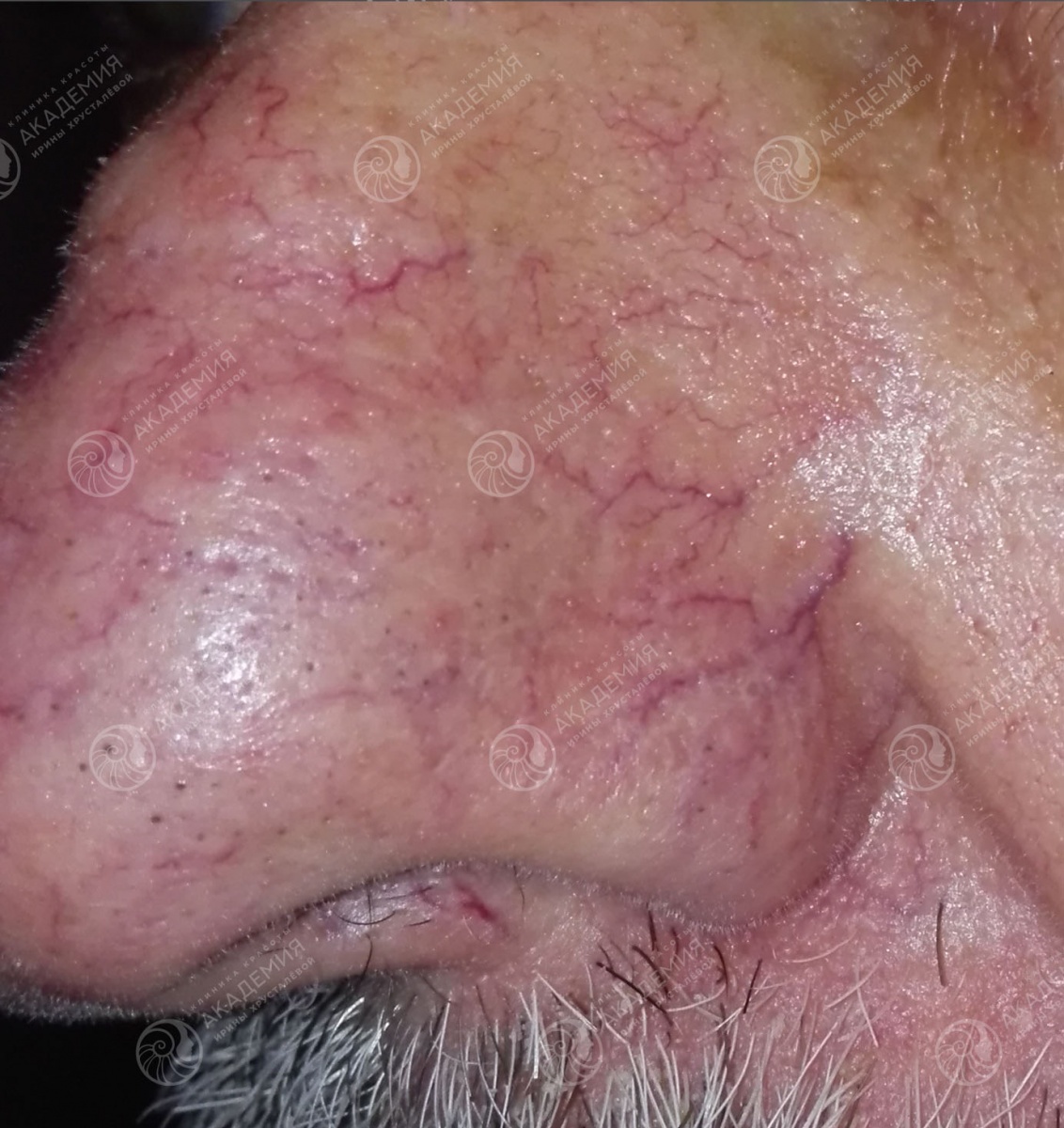 До: Фотокоагуляция сосудов. Лечение на аппарате М22