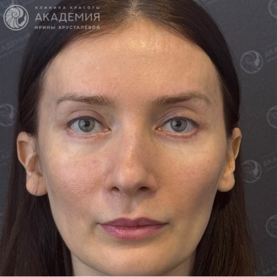 После: Повторный эндоскопический лифтинг средней трети лица и периорбитальной области, двухсторонняя кантопластика методом «tarsal strip», удлинение ретракторов нижних век с использованием спейсеров