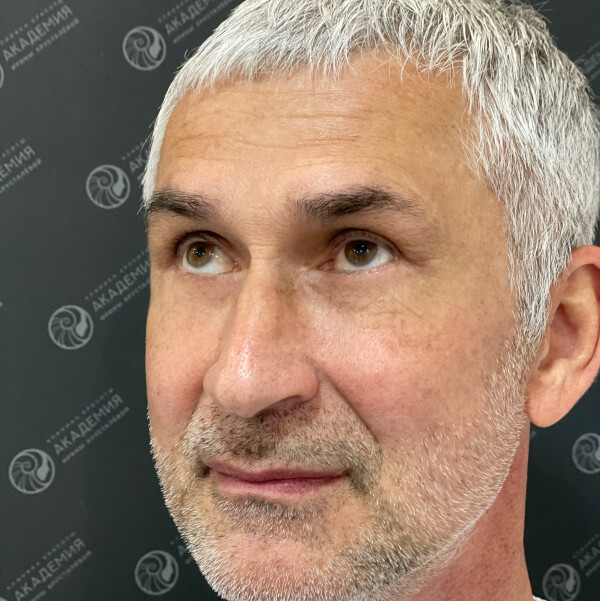 Ракурс 3 после: Full Face и Chin-Wing